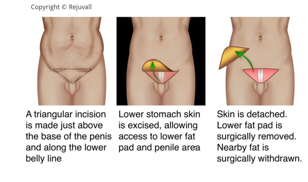 The importance of the fat pad in the lower abdomen area The importance of the fat pad in the lower abdomen area