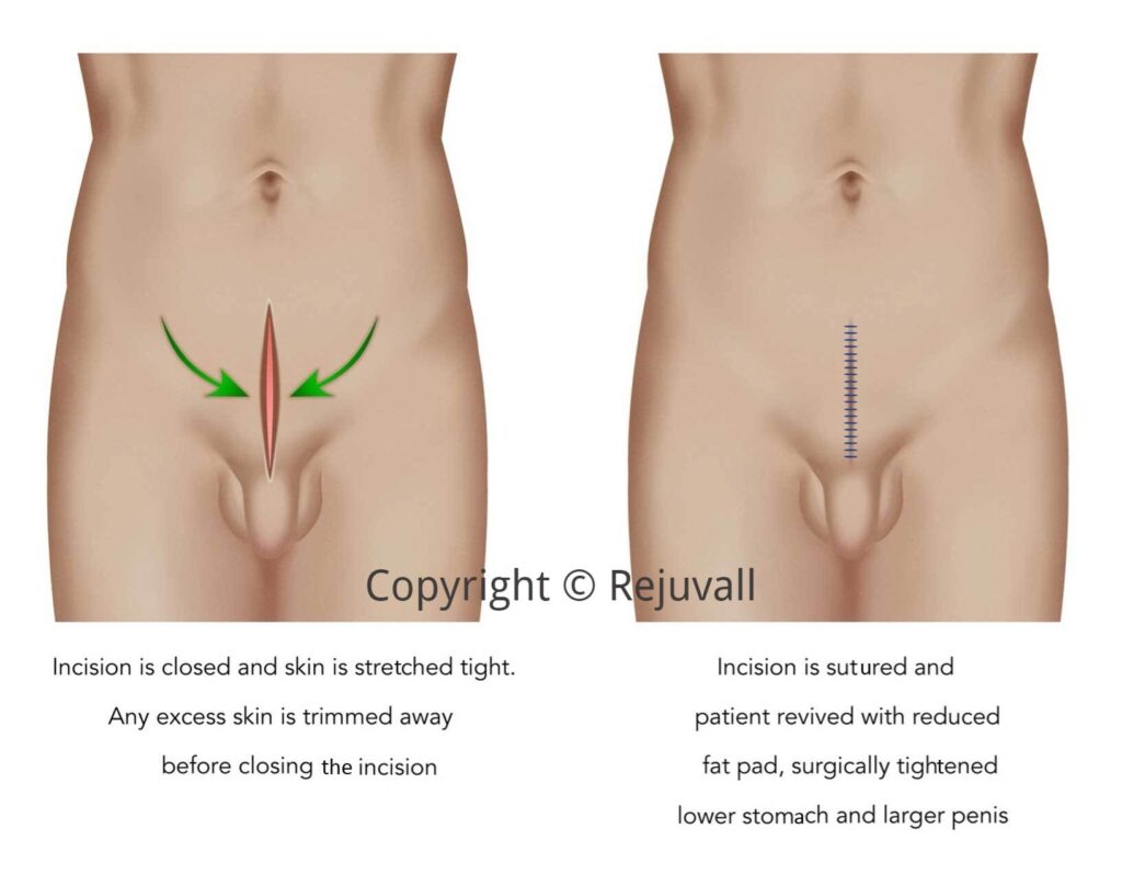 The importance of the fat pad in the lower abdomen area The importance of the fat pad in the lower abdomen area