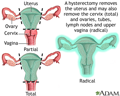 Understanding Hysterectomy: Procedure and Health Conditions Understanding Hysterectomy: Procedure and Health Conditions