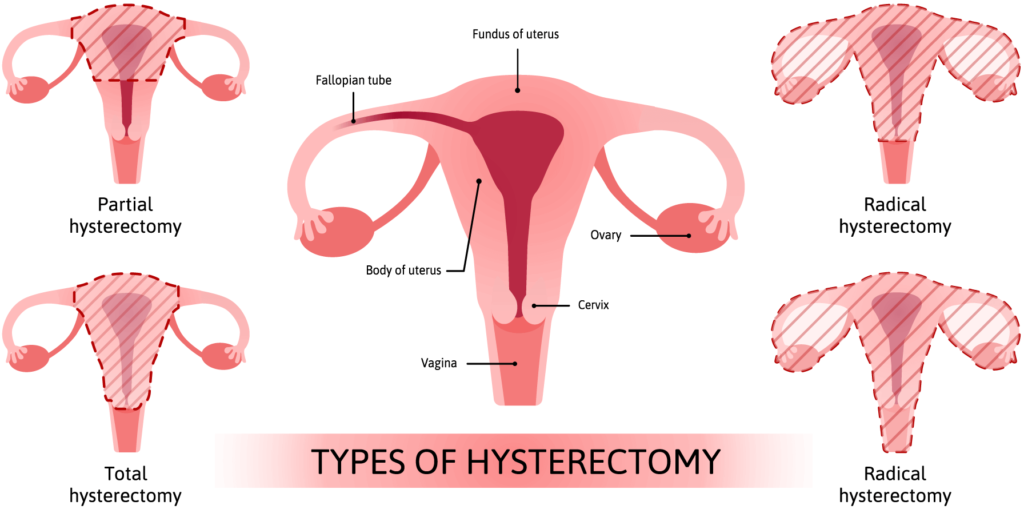 Understanding Hysterectomy: Procedure and Health Conditions Understanding Hysterectomy: Procedure and Health Conditions